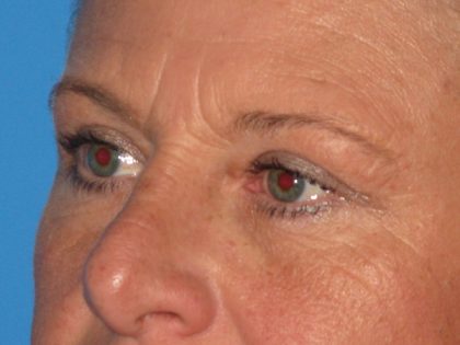 Blepharoplasty Before & After Patient #2182