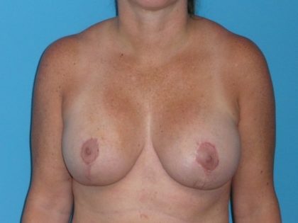 Breast Augmentation with Lift Before & After Patient #1702