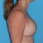 Breast Augmentation with Lift Before & After Patient #1702