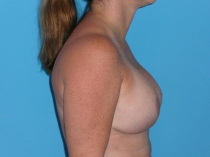 Breast Augmentation with Lift Before & After Patient #1702