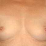 Breast Reconstruction Before & After Patient #1858