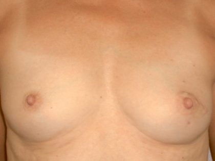 Breast Reconstruction Before & After Patient #1858