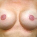 Breast Reconstruction Before & After Patient #1858