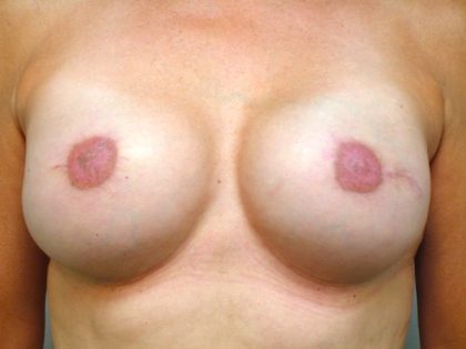 Breast Reconstruction Before & After Patient #1858