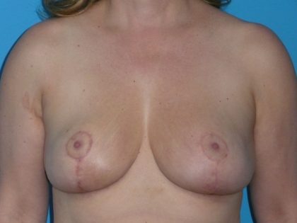 Breast Reduction Before & After Patient #1961