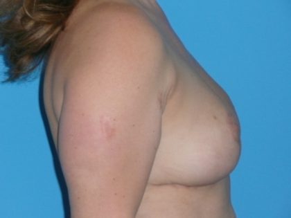 Breast Reduction Before & After Patient #1961