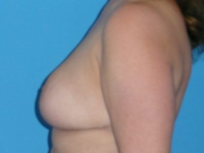 Breast Reduction Before & After Patient #1961