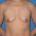 Breast Reconstruction Before & After Patient #1861