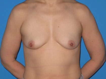 Breast Reconstruction Before & After Patient #1861