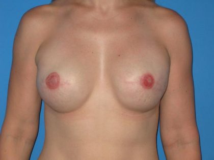 Breast Reconstruction Before & After Patient #1861