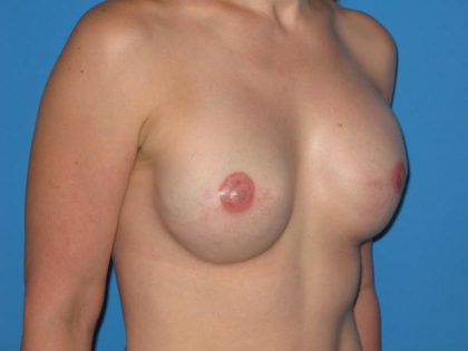 Breast Reconstruction Before & After Patient #1861