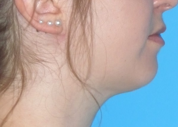 Liposuction Before & After Patient #2124