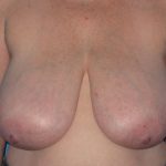Breast Reduction Before & After Patient #1983