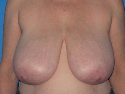 Breast Reduction Before & After Patient #1983
