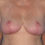 Breast Reduction Before & After Patient #1983