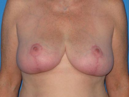 Breast Reduction Before & After Patient #1983