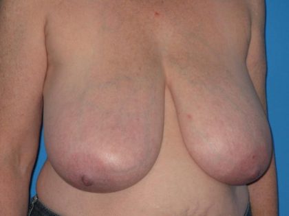 Breast Reduction Before & After Patient #1983