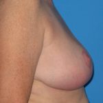 Breast Reduction Before & After Patient #1983