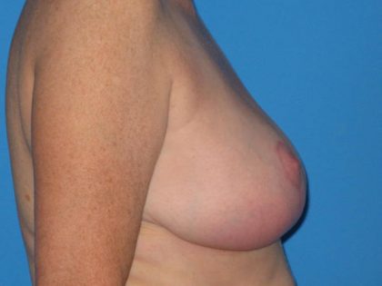 Breast Reduction Before & After Patient #1983