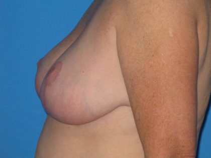 Breast Reduction Before & After Patient #1983