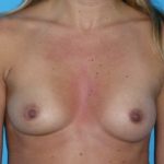 Breast Augmentation Before & After Patient #1602