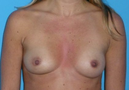 Breast Augmentation Before & After Patient #1602