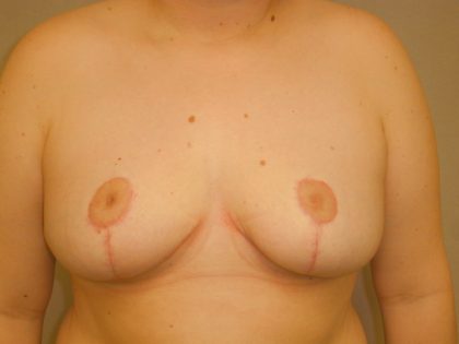 Breast Reduction Before & After Patient #1994