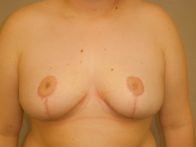 Breast Reduction Before & After Patient #1994