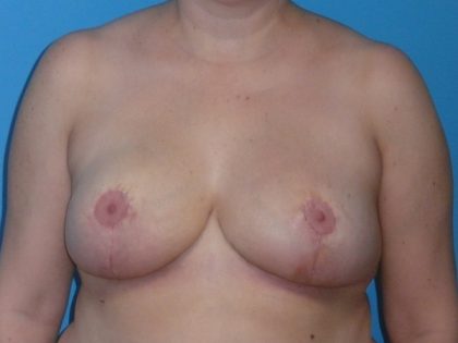 Breast Reduction Before & After Patient #1997