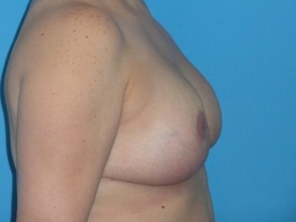 Breast Reduction Before & After Patient #1997