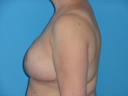 Breast Reduction Before & After Patient #1997