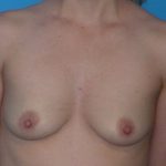 Breast Augmentation Before & After Patient #1613