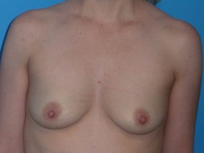 Breast Augmentation Before & After Patient #1613