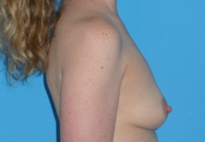 Breast Augmentation Before & After Patient #1613