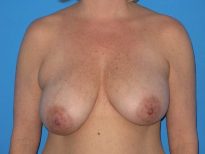 Breast Reduction Before & After Patient #2008