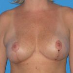 Breast Reduction Before & After Patient #2008