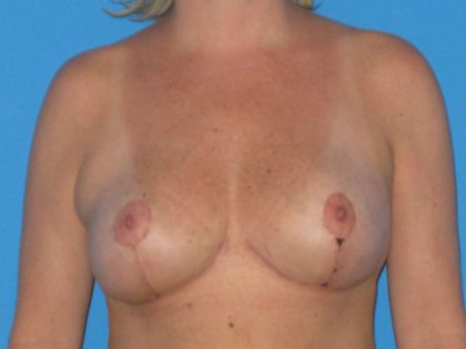Breast Reduction Before & After Patient #2008