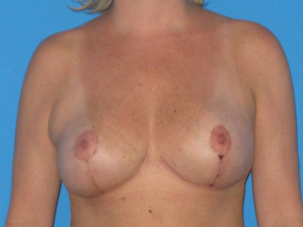 Breast Reduction Before & After Patient #2008