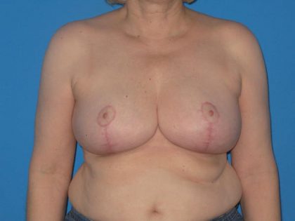 Breast Reduction Before & After Patient #2013