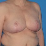 Breast Reduction Before & After Patient #2013