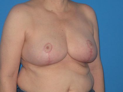 Breast Reduction Before & After Patient #2013