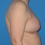 Breast Reduction Before & After Patient #2013