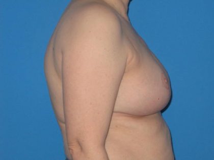 Breast Reduction Before & After Patient #2013