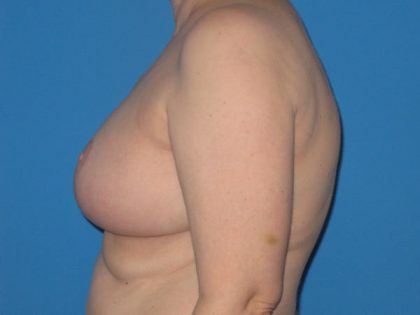 Breast Reduction Before & After Patient #2013