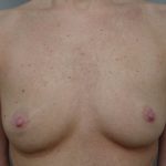 Breast Augmentation Before & After Patient #1624