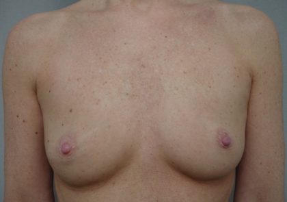 Breast Augmentation Before & After Patient #1624