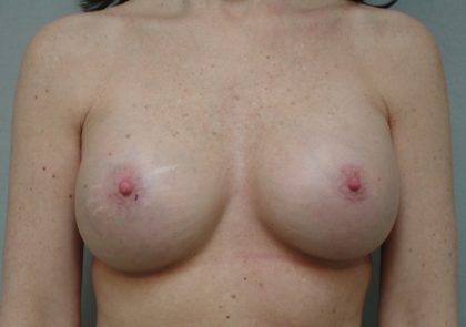 Breast Augmentation Before & After Patient #1624