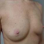 Breast Augmentation Before & After Patient #1624