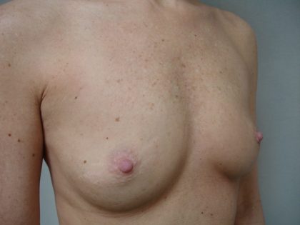 Breast Augmentation Before & After Patient #1624