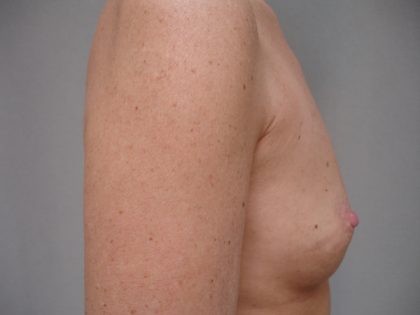 Breast Augmentation Before & After Patient #1624